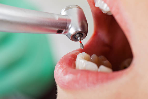 Best Emergency Tooth Extraction in Creve Coeur, IL